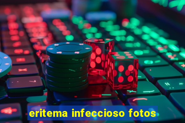 eritema infeccioso fotos