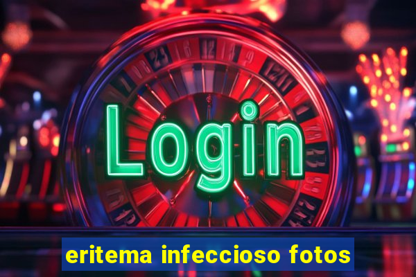 eritema infeccioso fotos